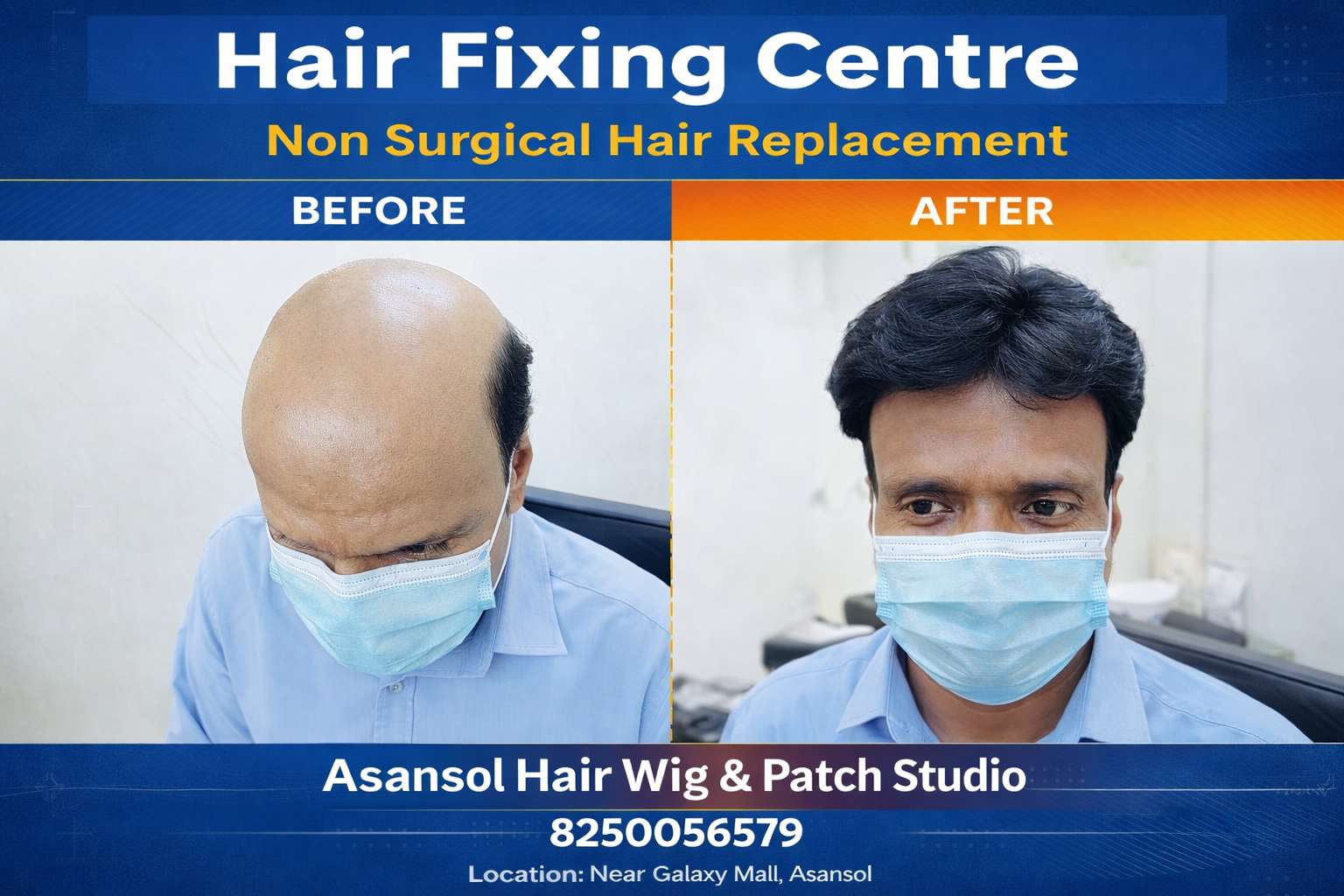 Hair Patch vs Hair Transplant: Which is Better for Hair Loss?