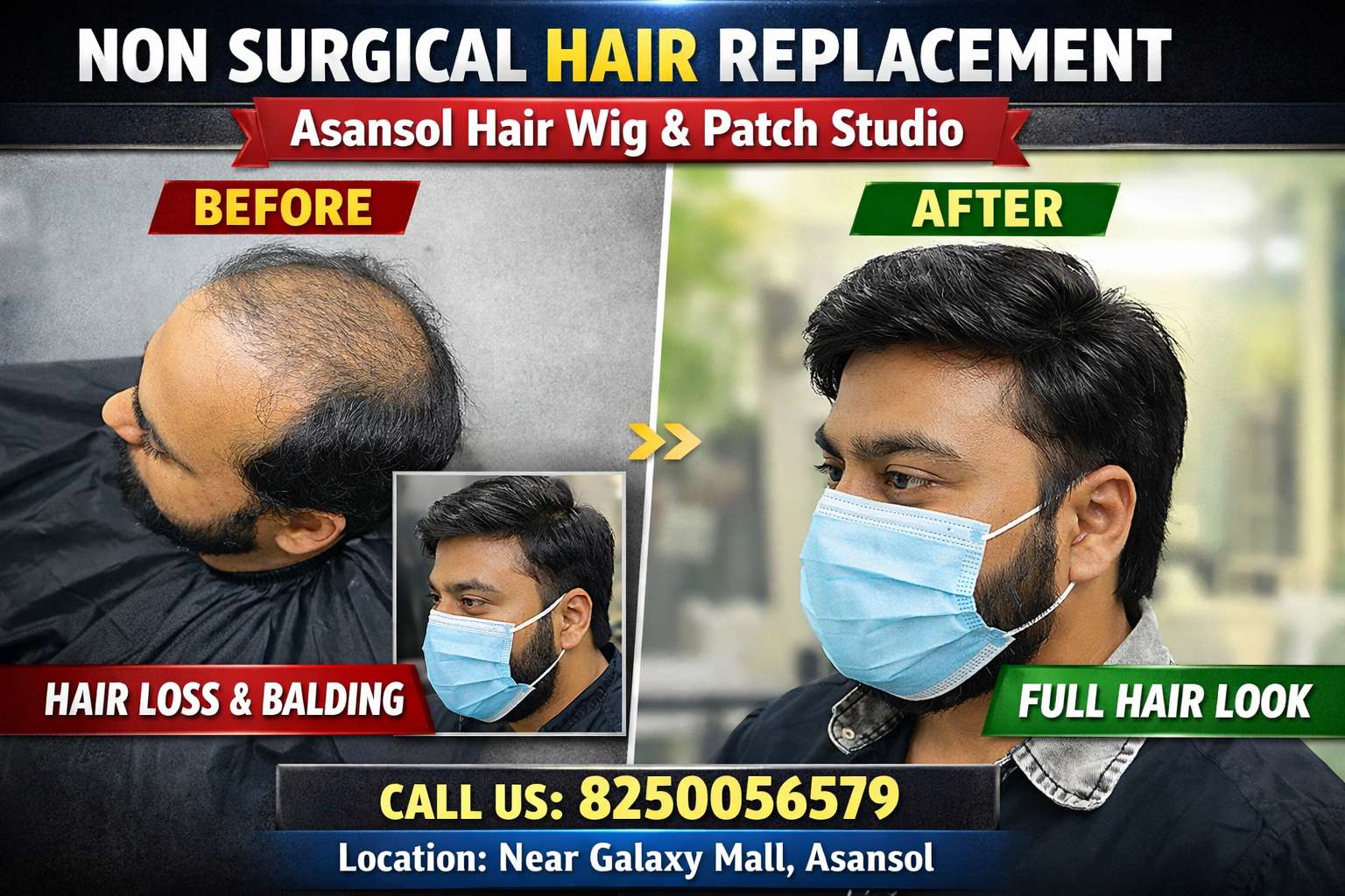 Cost of Hair Patch in Asansol